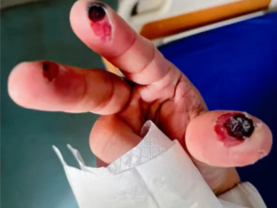 女子误踩身亡！警惕清洁剂中隐藏的“化骨水” 你家可能也有 ！